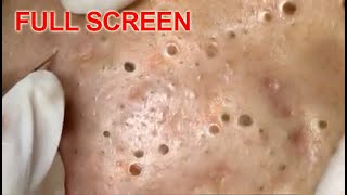 LARGE Blackheads Removal  Best Pimple Popping Videos [upl. by Ezechiel]