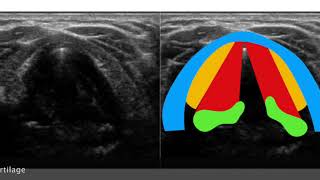 Neck Larynx Vocal cord paralysis [upl. by Dewey]