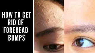 How to Get Rid of Forehead Bumps [upl. by Naujit]