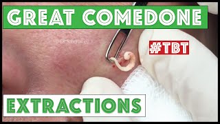 Greatest Blackheads and Whiteheads TBT [upl. by Casey]