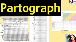 Partograph plotting  Nursing Lecture [upl. by Ahsaya]