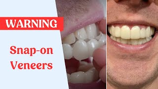 Snap On Veneers Warning [upl. by Samuela]