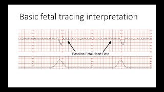 Interpreting Intrapartal fetal heart rate tracings [upl. by Esorylime545]